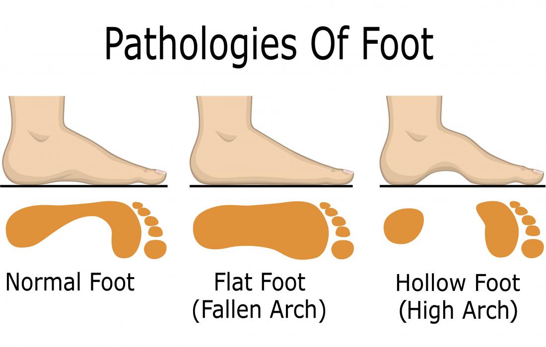 Düşen kemer ve düz ayaklara neden olan overpronation, oyuk olarak bilinen içi boş ya da yüksek kemerin yanında diyagramda gösterilmiştir.