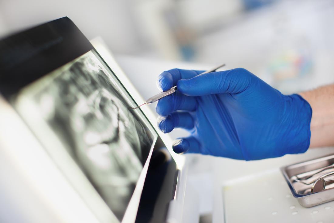 Dentiste sur le point d'effectuer une chirurgie parodontale pointant sur les dents et la radiographie de la gencive sur un écran, avec des outils chirurgicaux