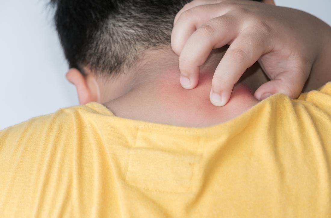 子供は背中にかゆみがあり、スポンジ状の皮膚炎