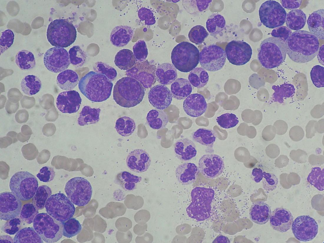 白血病細胞画像クレジット：Paulo Henrique Orlandi Mourao（2018年4月30日）。