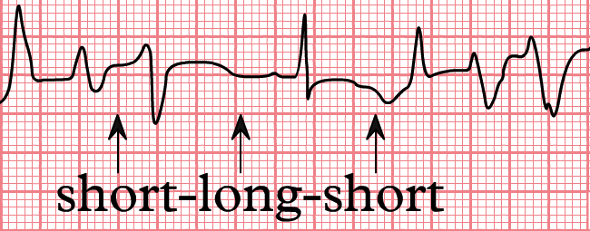 Torsades de düzensiz ritmi gösteren bir EKG.