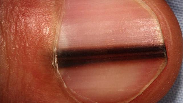 Melanoma subungueale che causa una linea nera sull'unghia.