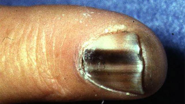 Субунуален меланом, предизвикващ черна линия на нокът.