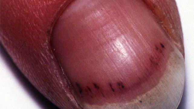 Склеротични кръвоизливи, причиняващи черни линии на ноктите.