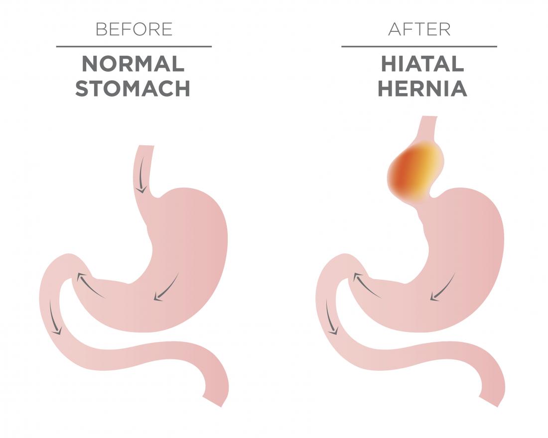 手術が必要な正常な胃および裂孔ヘルニアを示す画像