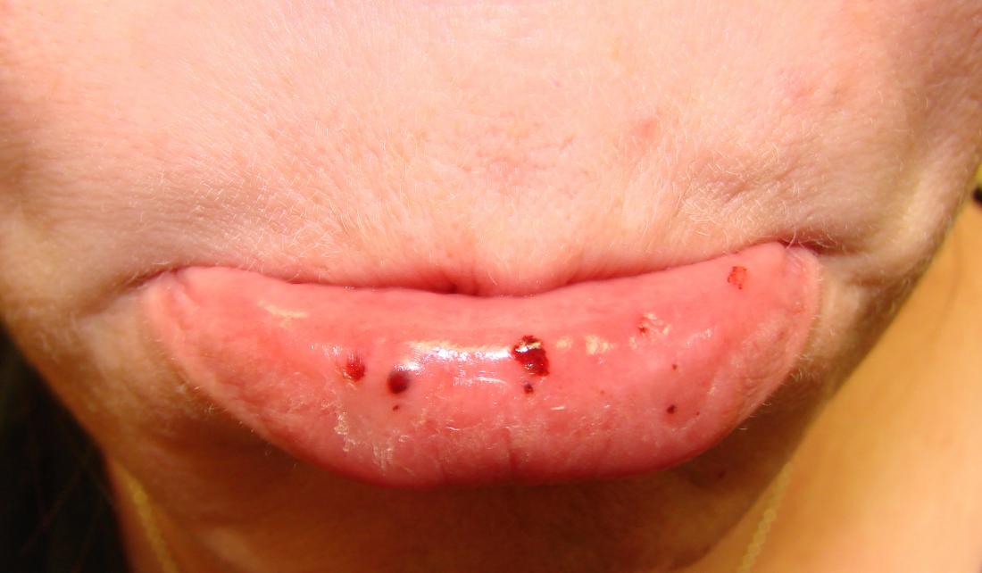 口腔紅斑/紫斑病。イメージクレジット：Mdscottis、（2008年、8月25日）。