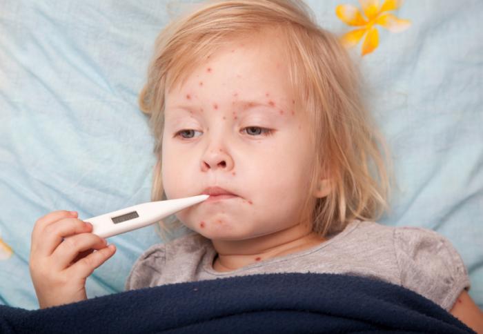 Un bambino con la varicella
