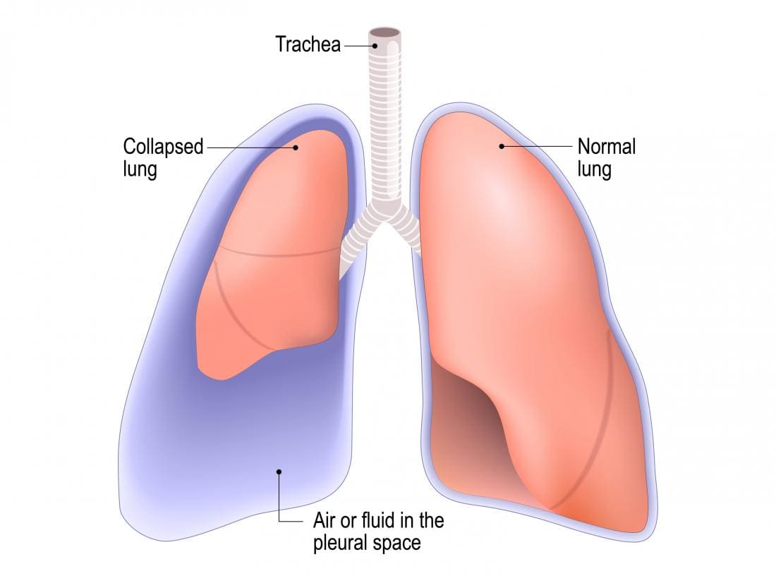 Diagramme d'un poumon effondré qui peut être causé par un poumon perforé