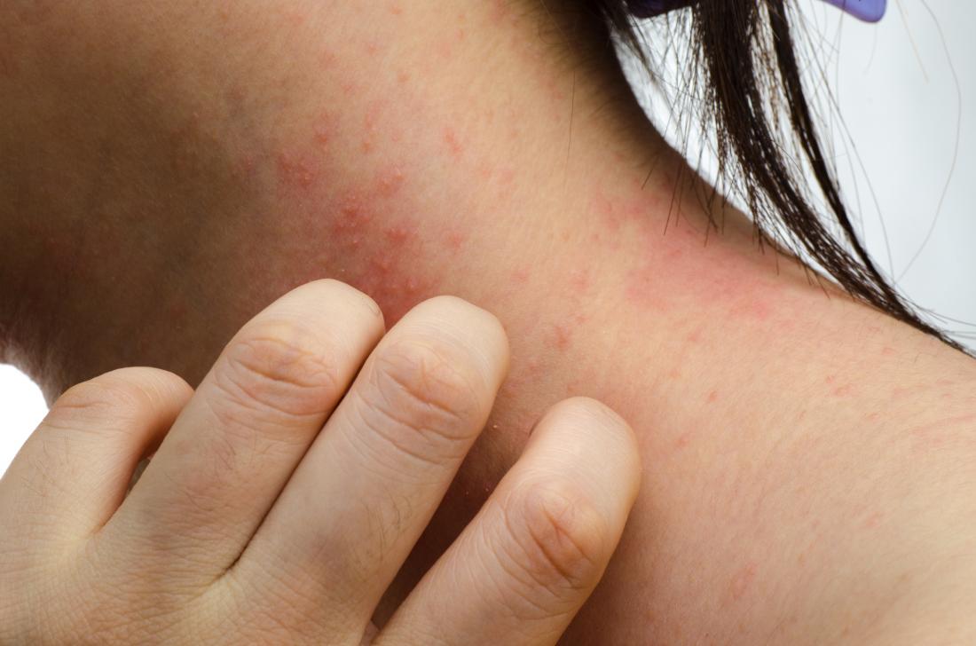 una donna con eczema sul collo