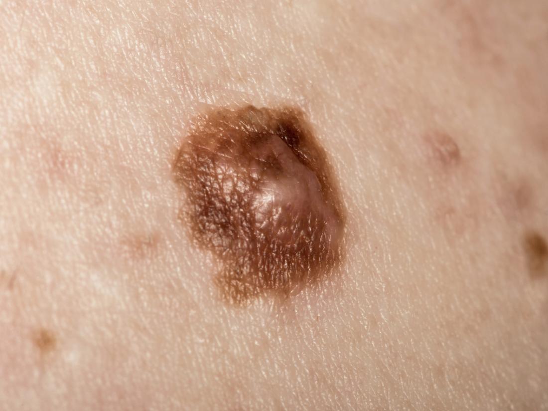 Меланом на рак на кожата изображение