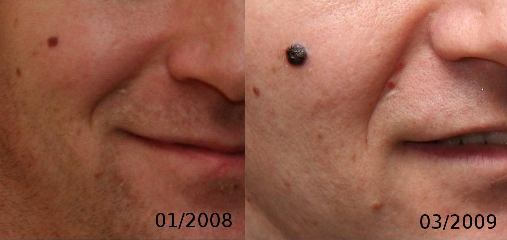 nodular melanoma image credit 0x6adb015 собствен труд, 2011