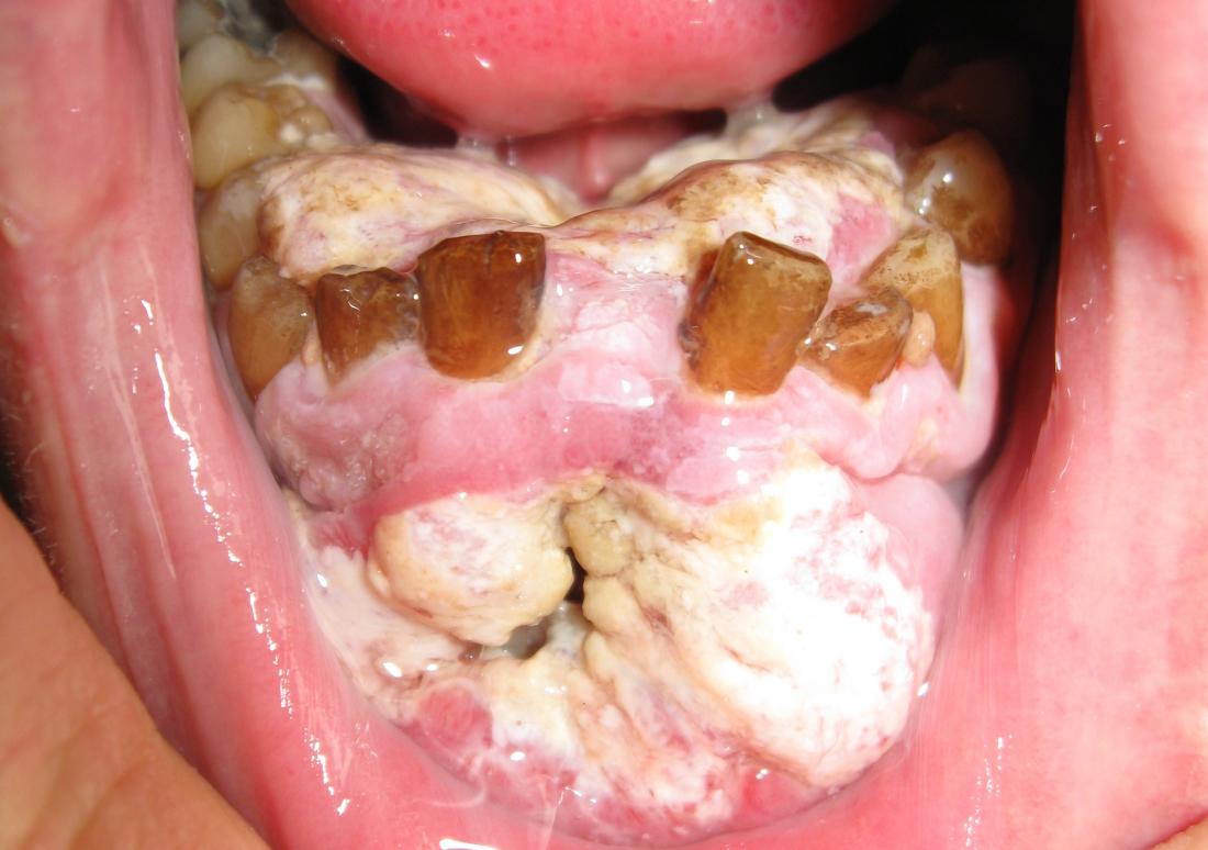 Рак на устата при 40-годишен пушач