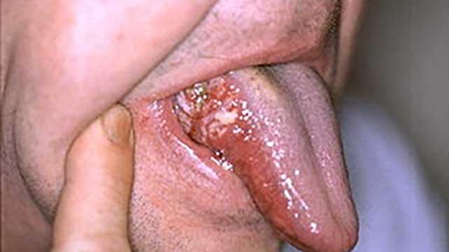 舌の癌