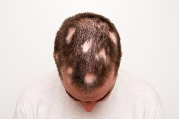 Uomo con alopecia