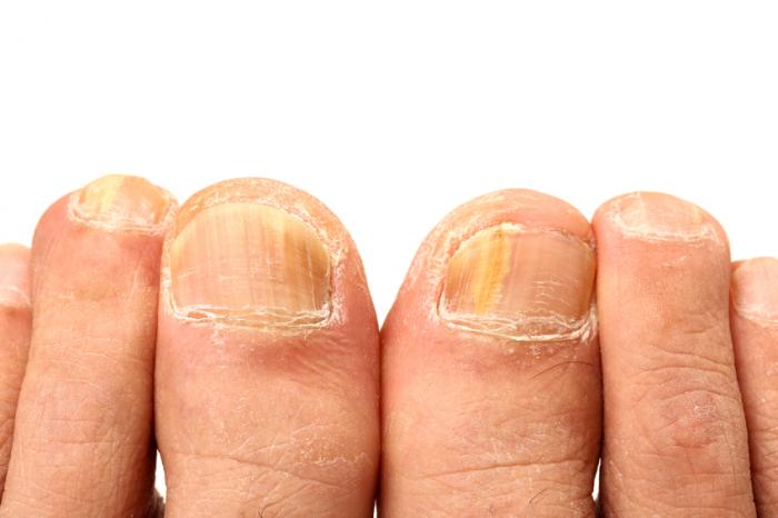 Dedos e unhas com uma infecção fúngica.
