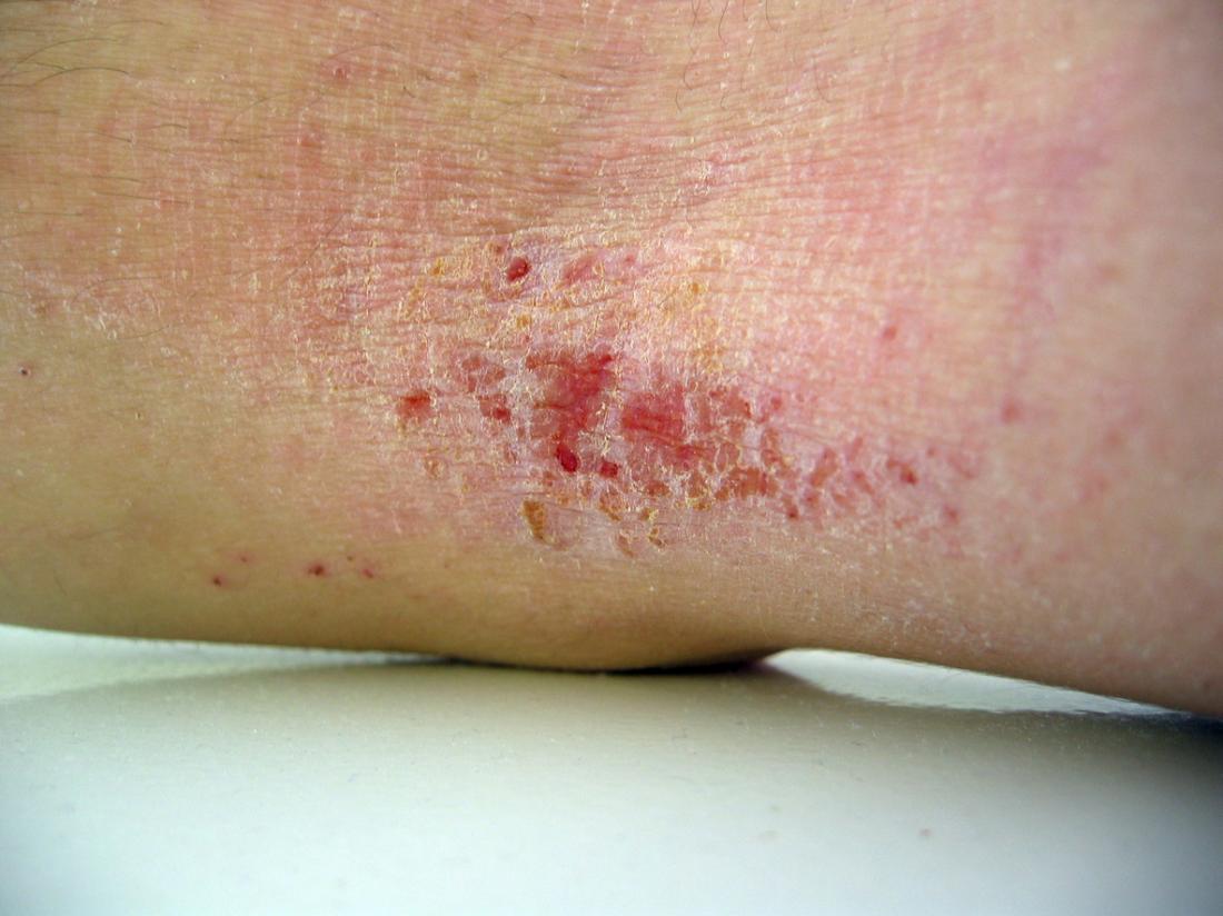 eczema su un braccio