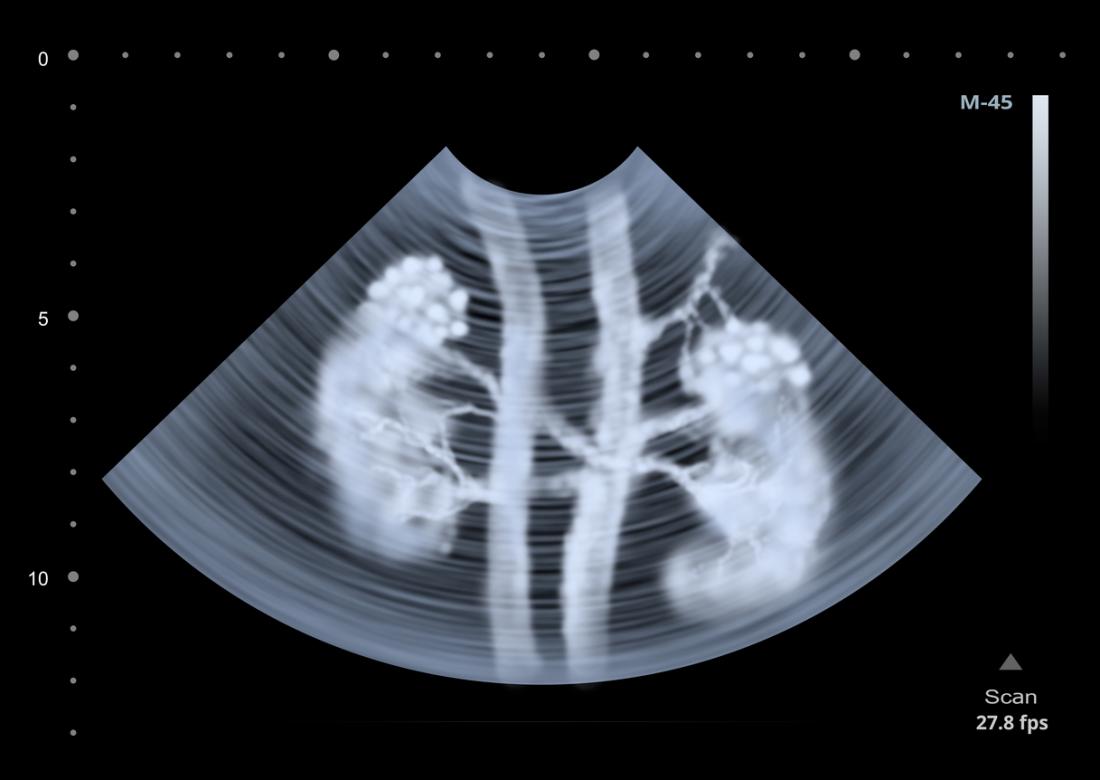 Scansione ad ultrasuoni di reni.
