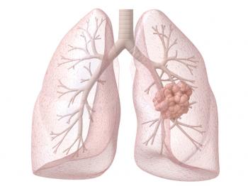 diagramma del cancro del polmone