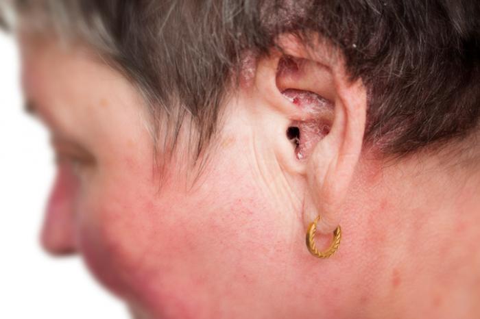耳の乾癬