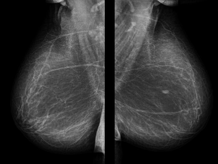 Immagini mammografiche