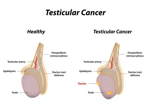 Diagramma di testicoli con cancro ai testicoli