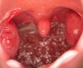 vista a bocca aperta di tonsille