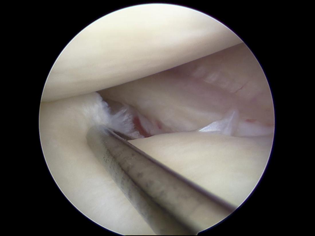 Артроскопски изглед на разкъсания менискус в коляното.