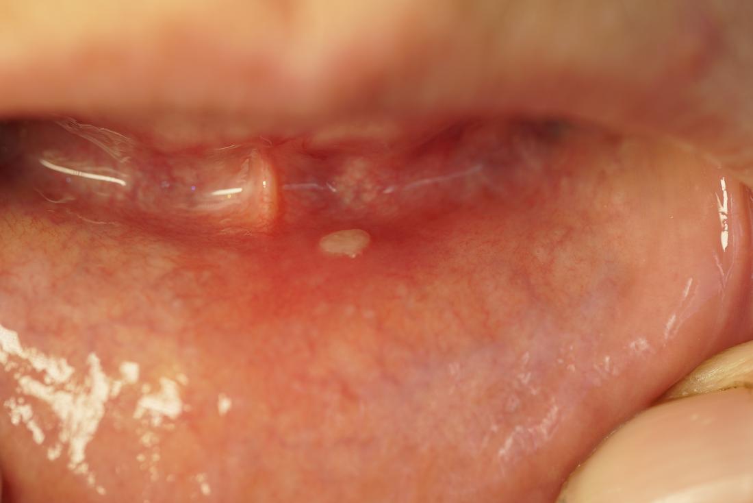 Бялото петно ​​върху венците често се причинява от язви в устата