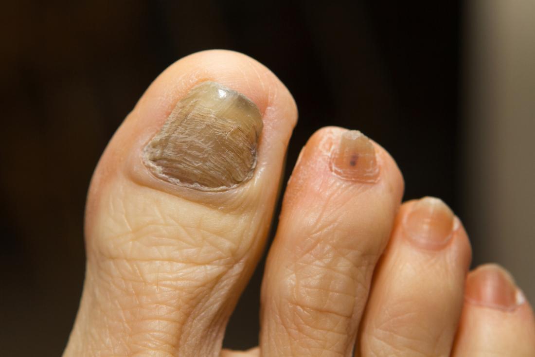 Infezione fungina chemioterapica nelle unghie dei piedi.