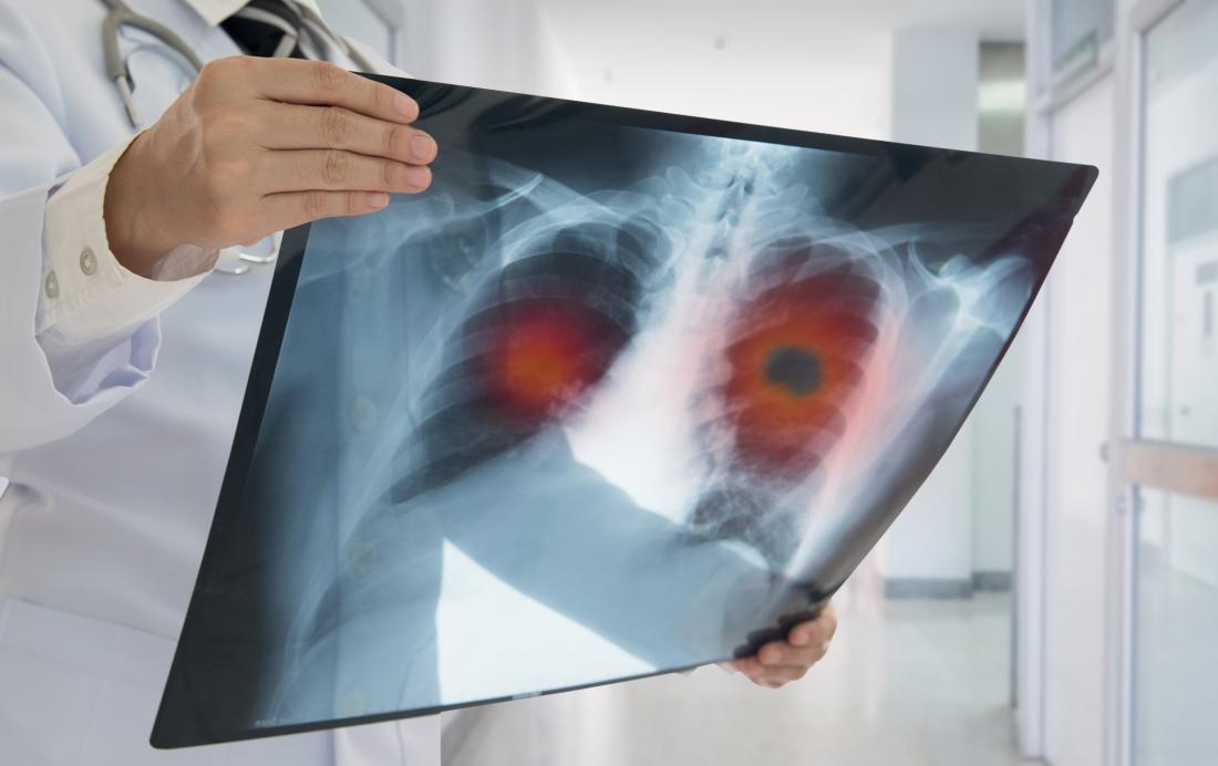 Dottore guardando a raggi X polmone