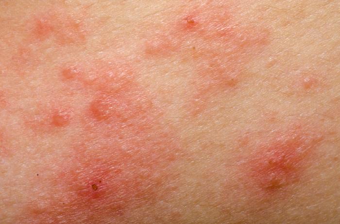 Eruzione di eczemi
