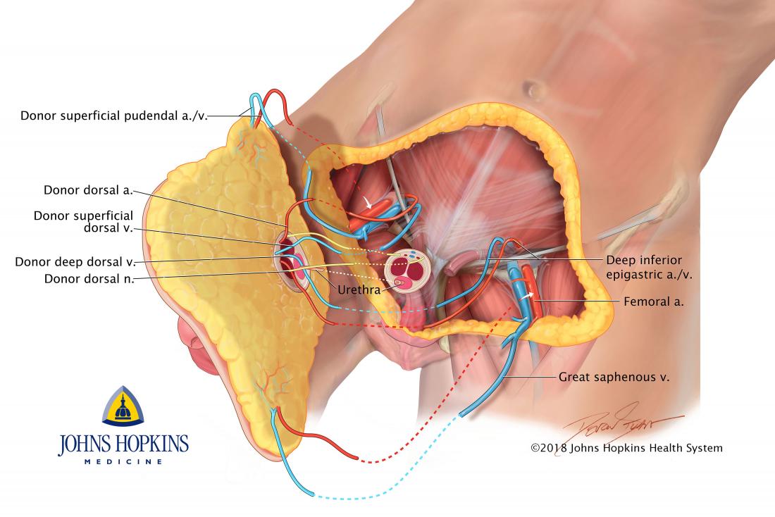 schéma de transplantation du pénis et du scrotum