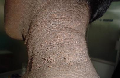 Nosorożce rogowacenia mogą powodować czarną szyję