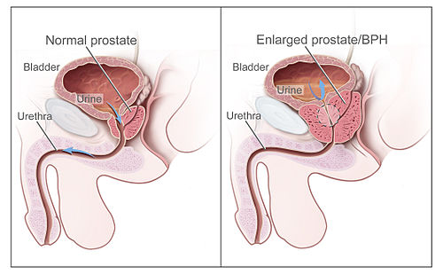 Benigne Prostatahyperplasie nci-vol-7137-300