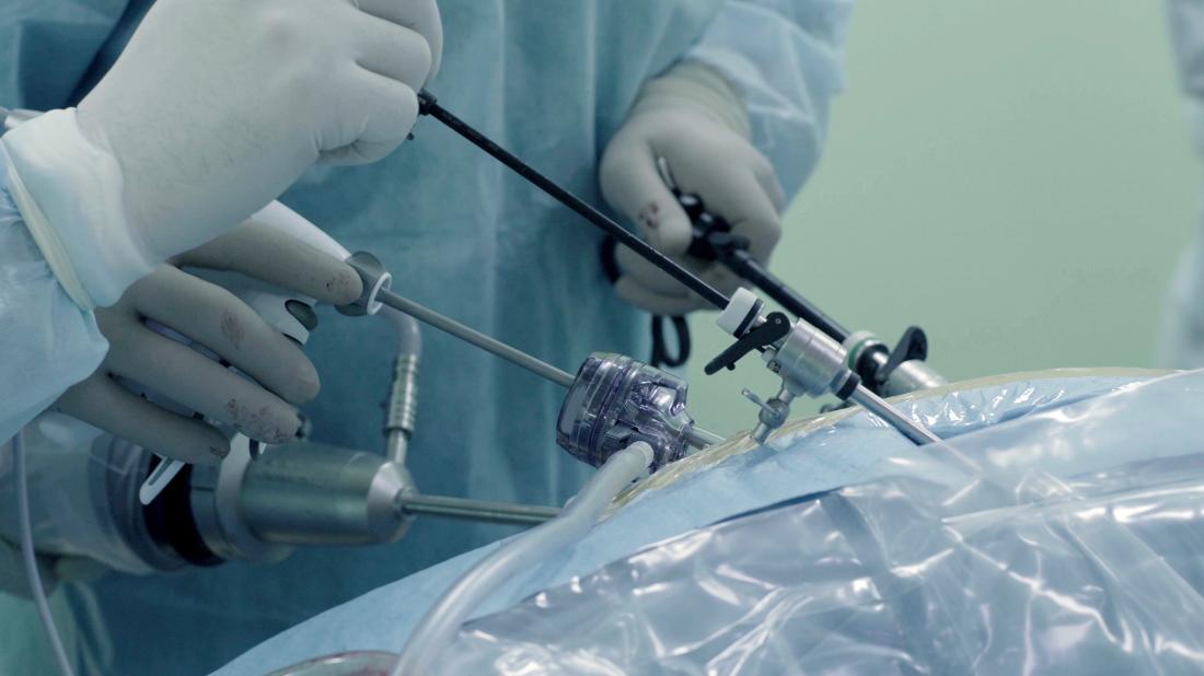 Tout Sur La Laparoscopie Guide Complet Et Actualis 
