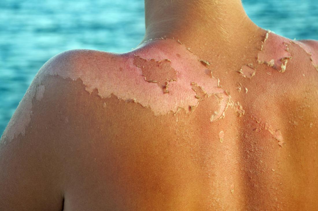 Peeling Haut durch Sonnenbrand.