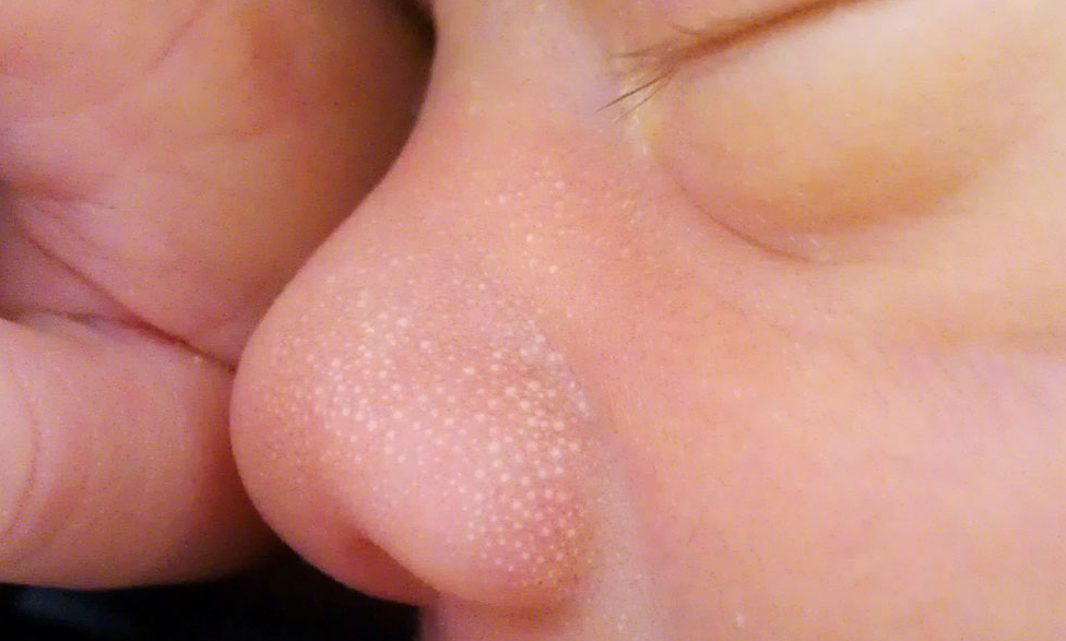 幼児の鼻の上にミリアのクローズアップ