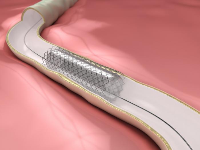 илюстрация на стент за коронарна артерия