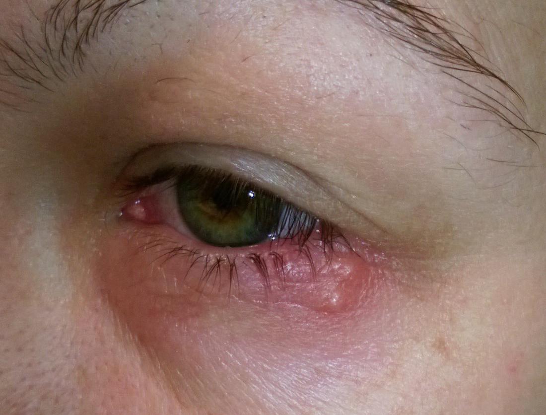 Augen-Herpes