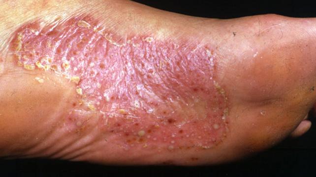 足の掌蹠膿疱症