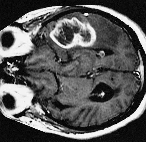 glioblastoma multiforme, mostrado na ressonância magnética de uma pessoa com EM tumefativa. Crédito da imagem: Instituto de Patologia das Forças Armadas, (2008, 2 de julho).