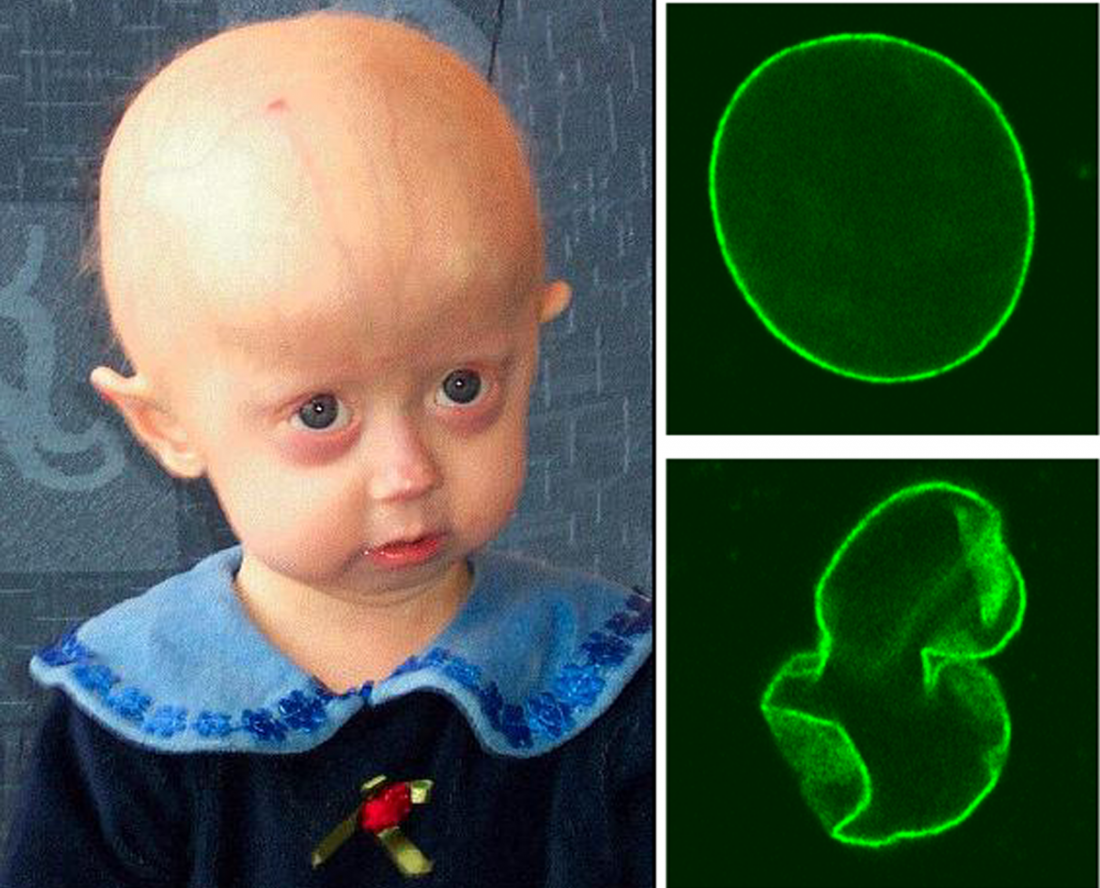 [Progeria - Scaffidi, P., The Cell Nucleus and Aging: Tantalizing Clues and Hopeful Promises, PLoS Biology, 2005 </ br>]”></p> <p align=