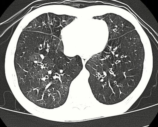 ポップコーン肺のスキャン、閉塞性細気管支炎