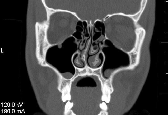 CT сканиране на отклонения септум 