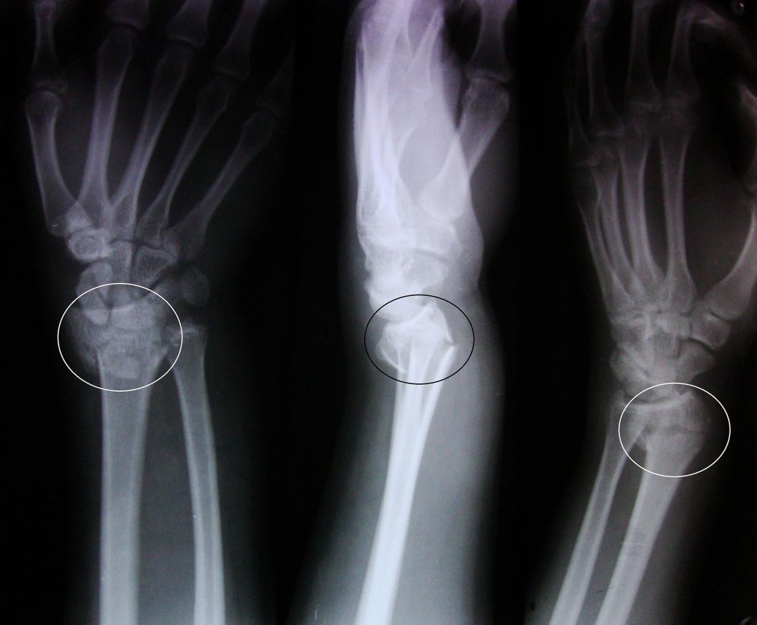 Colles fracture. 