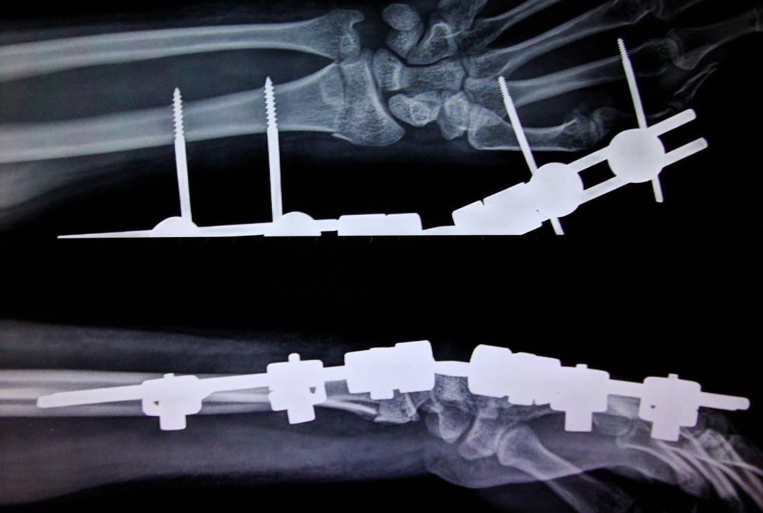 Cổ tay bị biến dạng sau khi gãy xương Colles. 