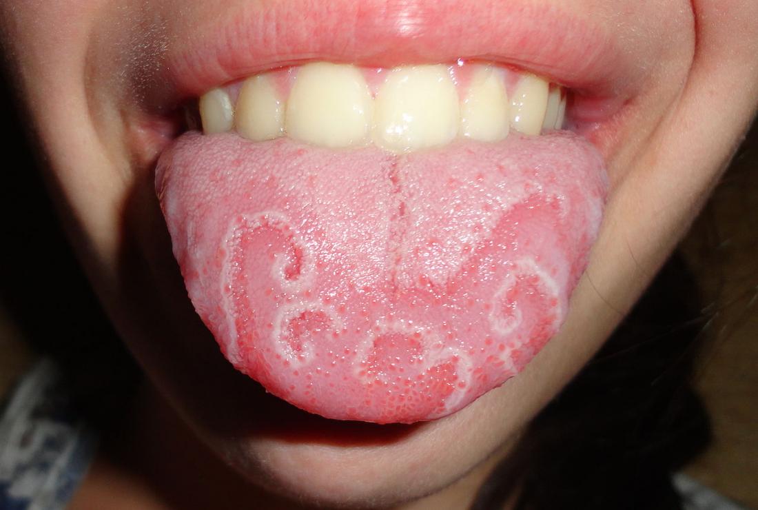 Geographic tongue pattern 