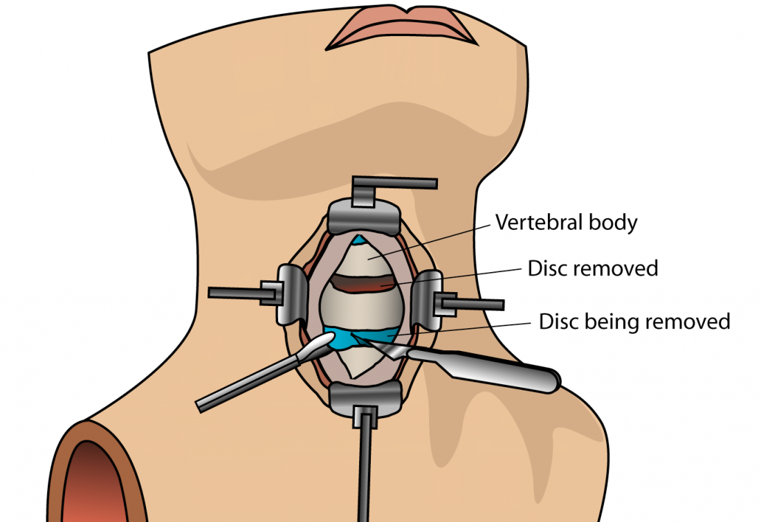 Discectomia cervical anterior e cirurgia de fusão 