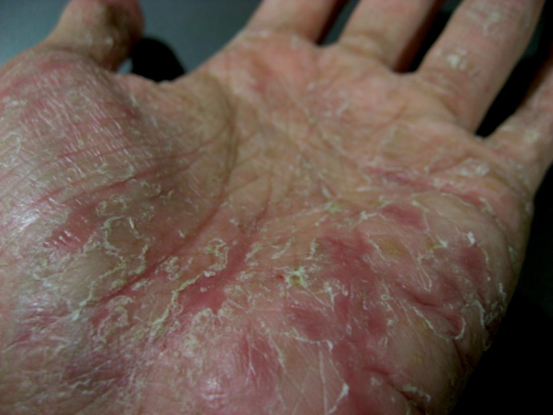 immagine della mano delle persone con eczema disidrotico 